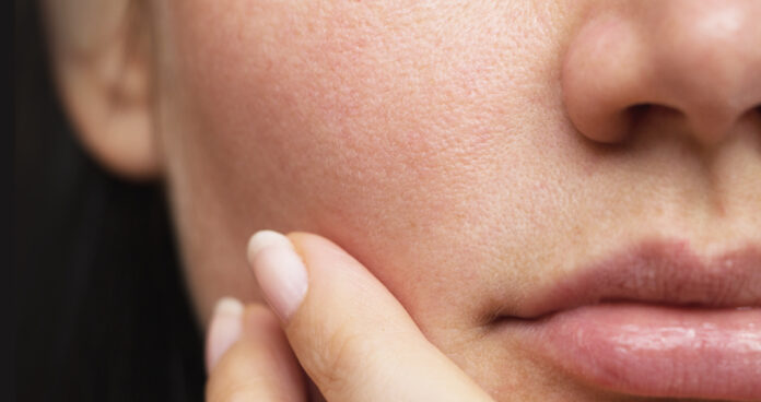 Pori Dilatati Pori Dilatati